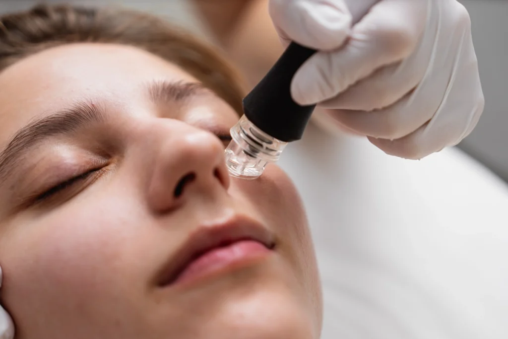 Voici comment savoir si c'est une bonne idée de mettre de la Cicalfate après ton microneedling
