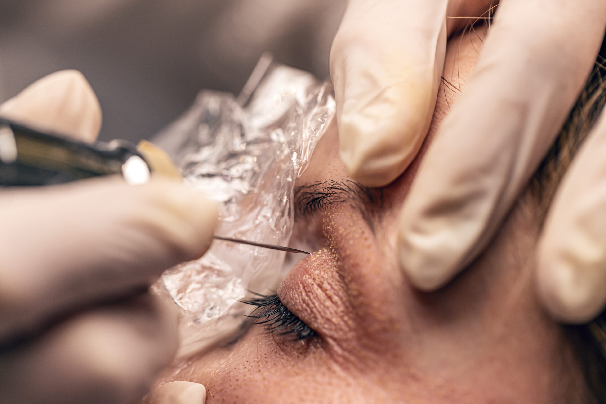 Voici comment choisir entre Blépharoplastie et botox pour tes paupières